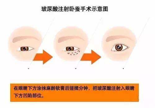 玻尿酸填卧蚕效果好不好？要多少钱？项目介绍和优缺点盘点