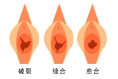 处女膜修复
