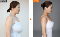巨大乳房缩小